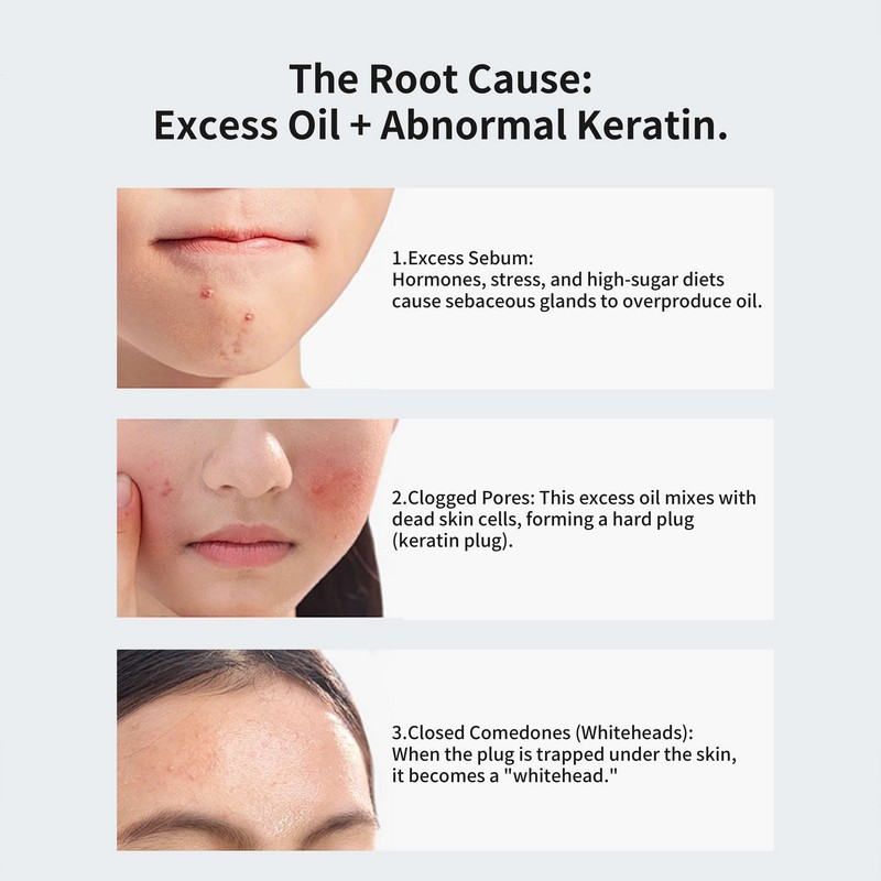 Teen skin problems cause